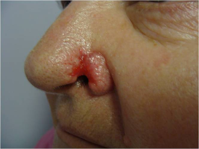 Reconstruction of the defect of the nose skin graft - after 6 months
